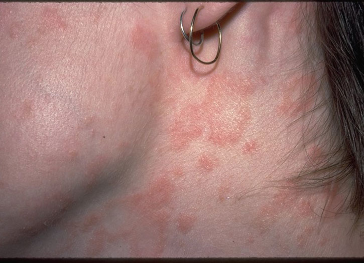 eczema-in-pictures-mild-to-severe-eczema-eczema-living