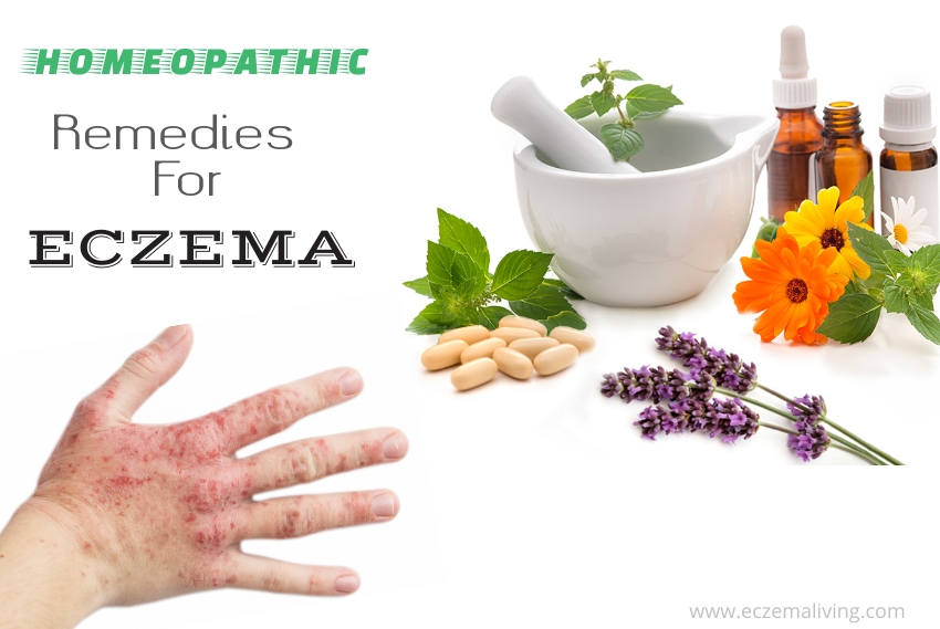 Homeopathic remedies for eczema on legs