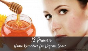 Home Remedies for Eczema Scars