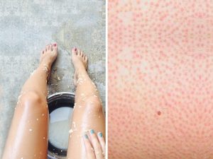 Follicular eczema