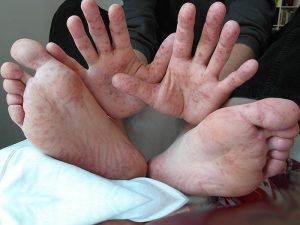 Eczema-Herpeticum -Rare-and-Fatal-Skin-Infection