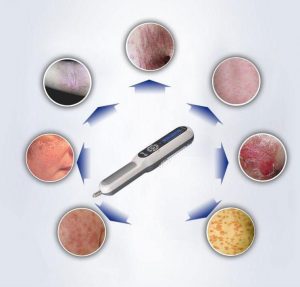 Phototherapy for Eczema