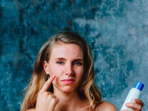 Perioral Dermatitis Symptoms, Causes and Treatment