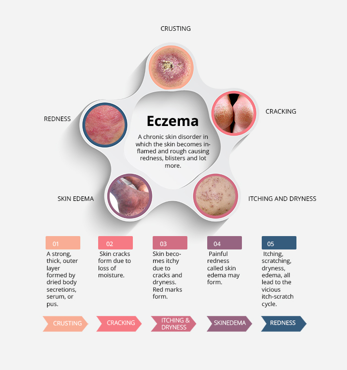 eczema-molluscatum-the-rare-viral-infection