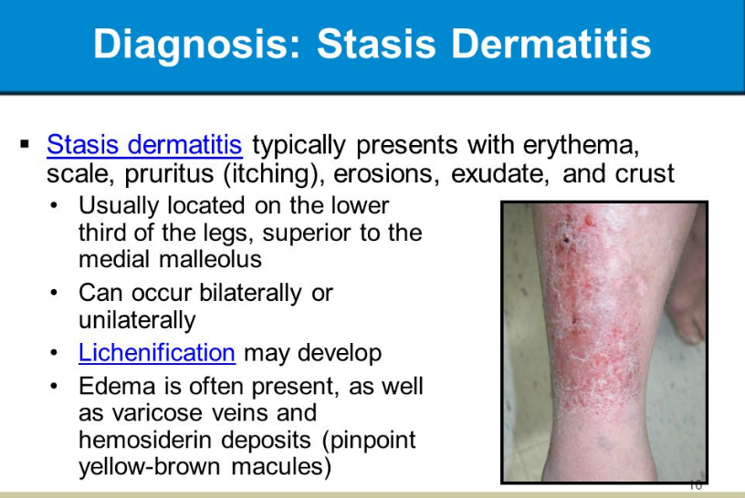 Stasis Dermatitis(Eczema On Legs) Symptoms Causes & Treatment