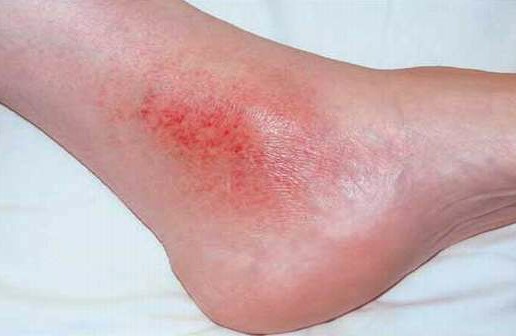 Stasis Dermatitiseczema On Legs Symptoms Causes And Treatment