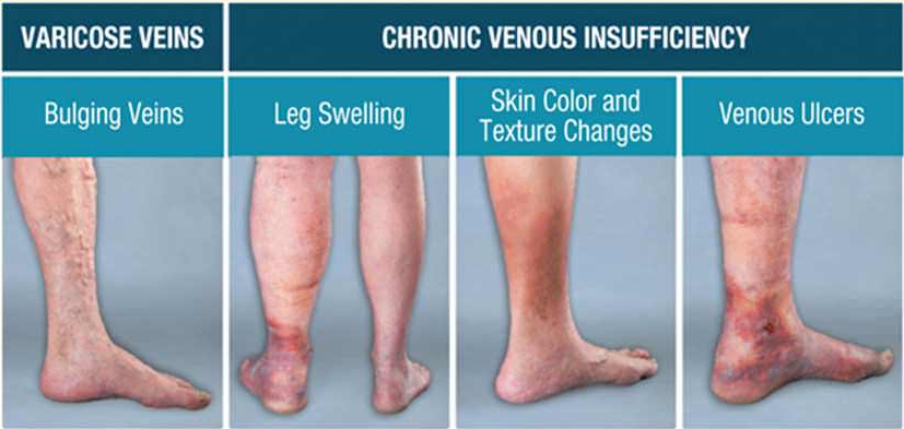 Stasis Dermatitiseczema On Legs Symptoms Causes And Treatment