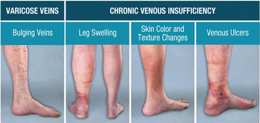 Screening And Diagnosis Of Early Stages Of Chronic Ve