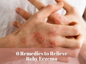 Remedies to Relieve Itchy Eczema