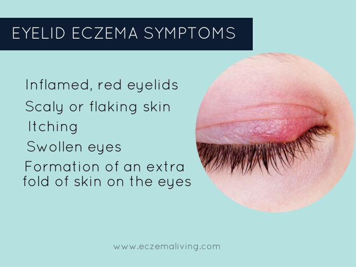 eyelid-dermatitis-how-to-get-rid-of-eczema-on-eyes