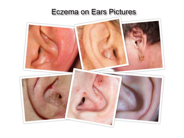 Eczema On Ear How To Get Rid Of Itchy Or Dry Ear Eczema 