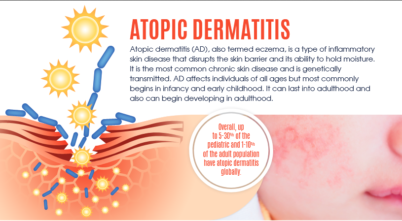 Atopic Dermatitis - Eczema Infographic - Interesting Facts 2019