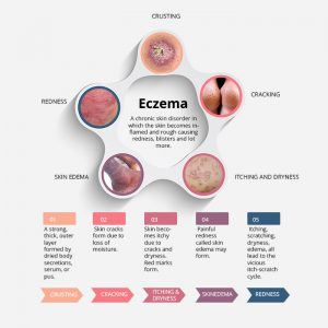 8 Most Common Eczema Triggers in 2019 - An INFOGRAPHIC