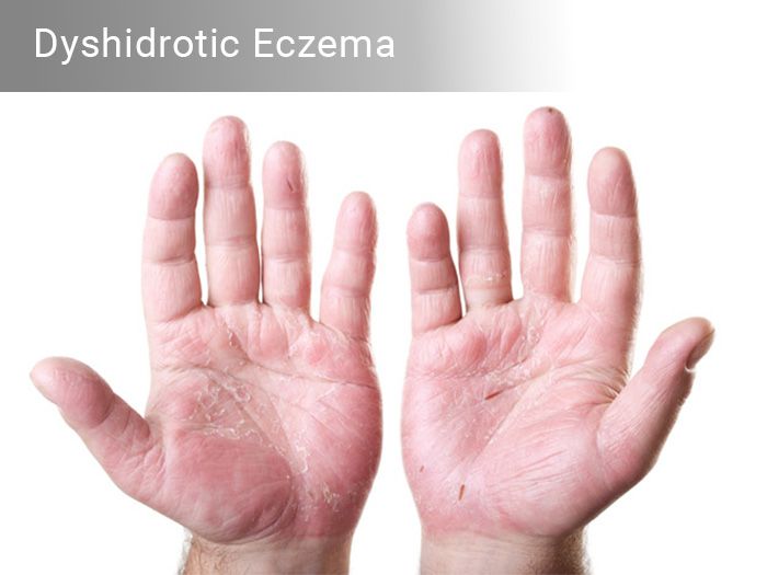 Dyshidrotic Eczema – Natural Home Remedies & Treatment
