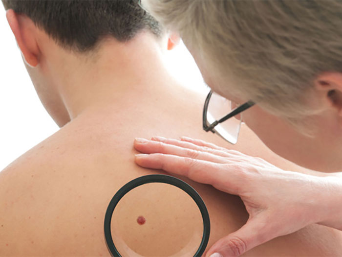 Patch Testing for Allergic Contact Dermatitis