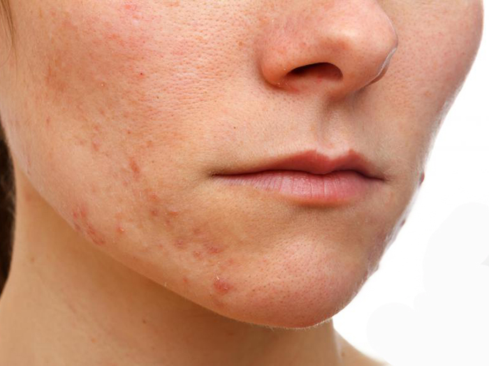 eczema face