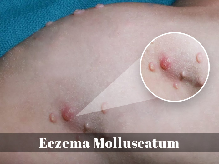 Eczema Molluscatum – Viral infection in Patients With Atopic Dermatitis