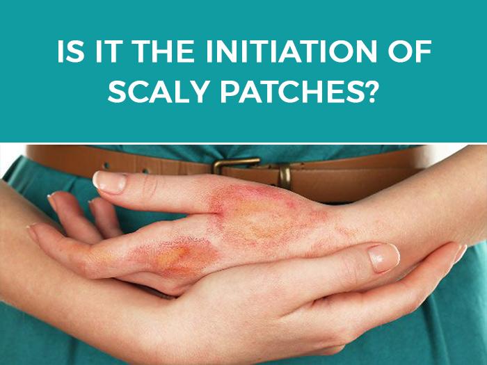 Is it a Normal Itch-Scratch Cycle or Neurodermatitis?