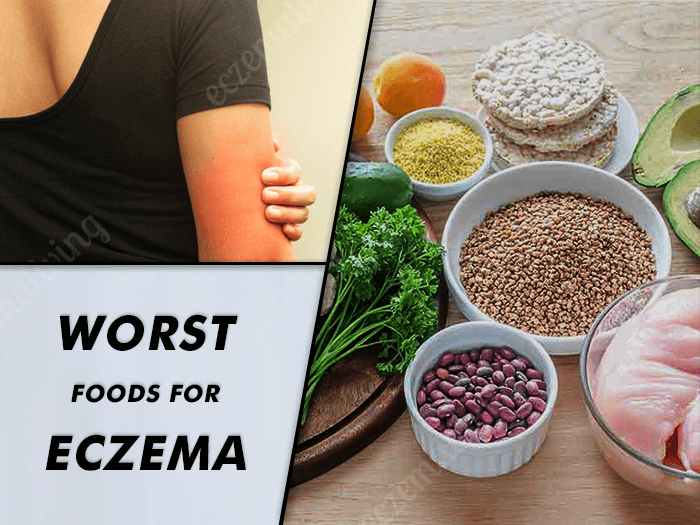 Food Triggers Eczema – Foods to Avoid To Get Rid Of Eczema
