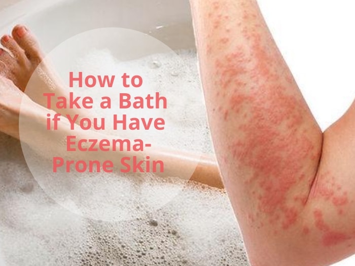 Eczema and Bathing – How to Take Bath With Eczema?