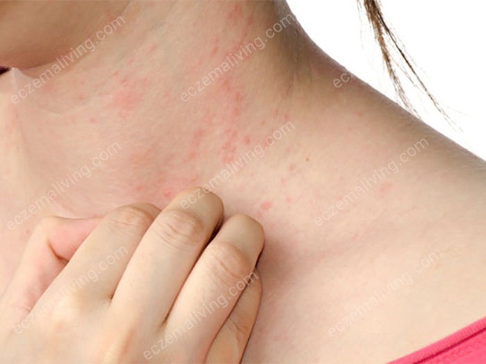 Eczema On Neck – How To Get Rid of Neck Eczema?