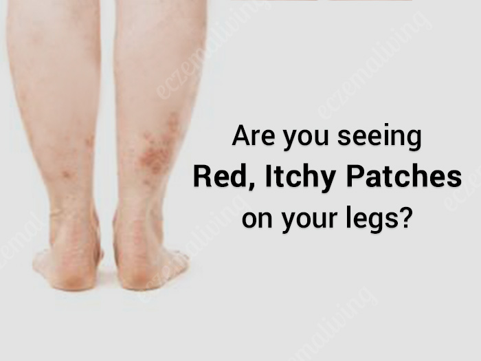 Stasis Dermatitis – Eczema on Legs – Causes & Treatment
