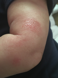 Weeping Eczema images